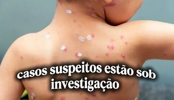 Ijuí registra possível surto de catapora após 12 casos confirmados 